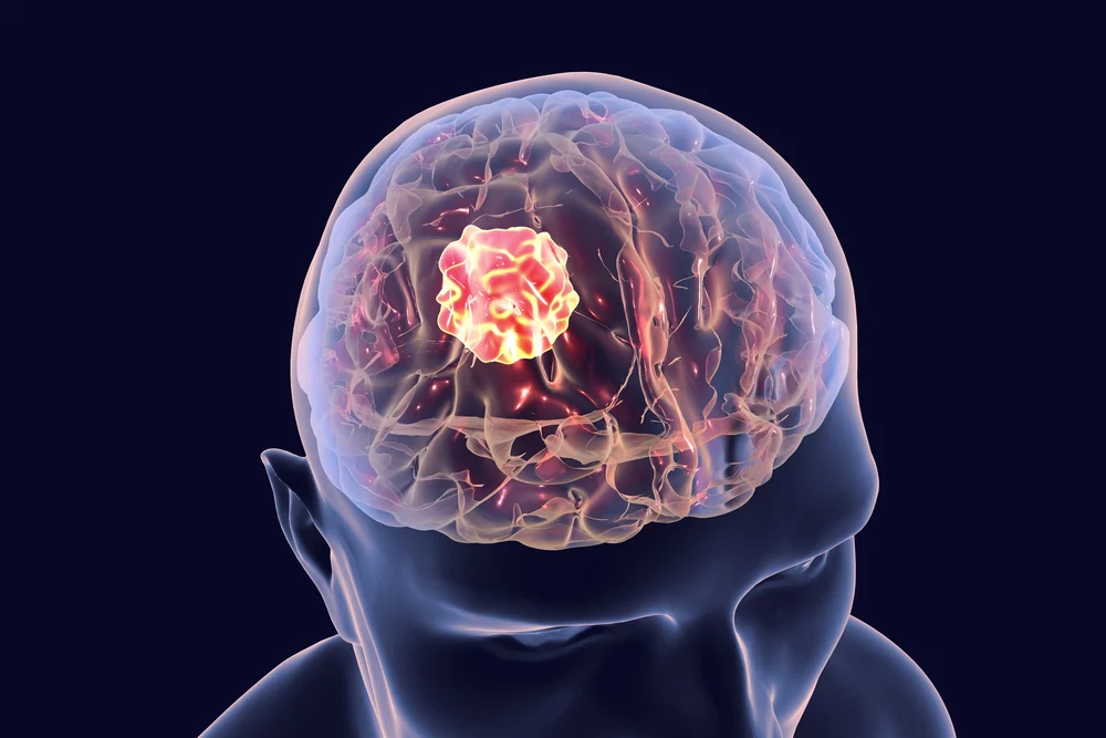 Хирургия опухолей головного мозга с помощью нейронавигации