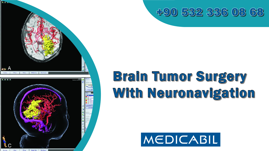 Brain Tumor Surgery With Neuronavigation