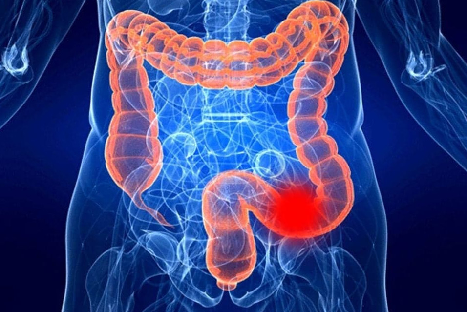 Рак толстой кишки у молодых людей: тревожная тенденция