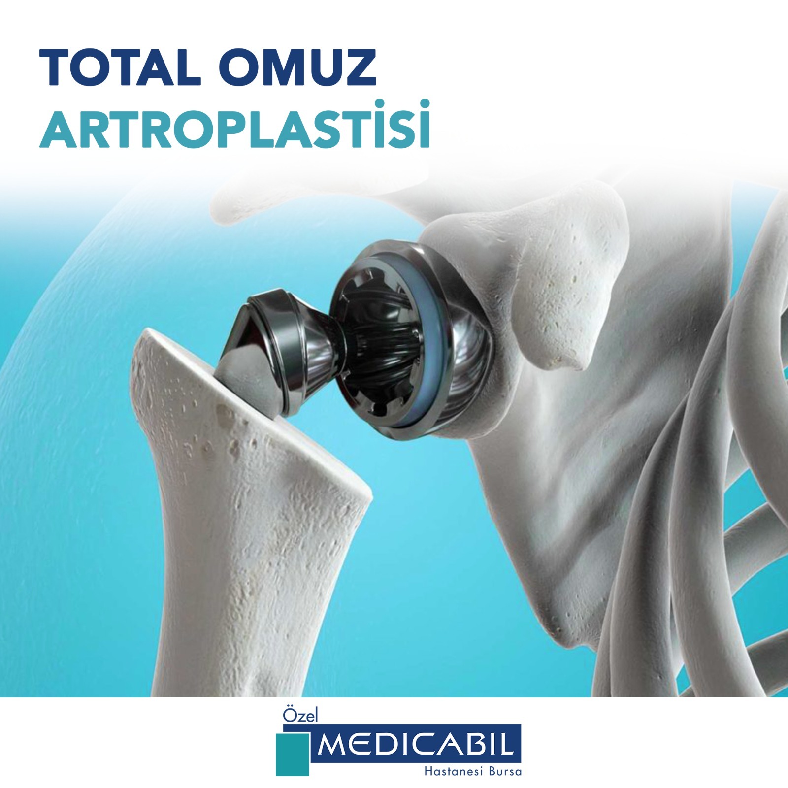 Total Omuz Artroplastisi