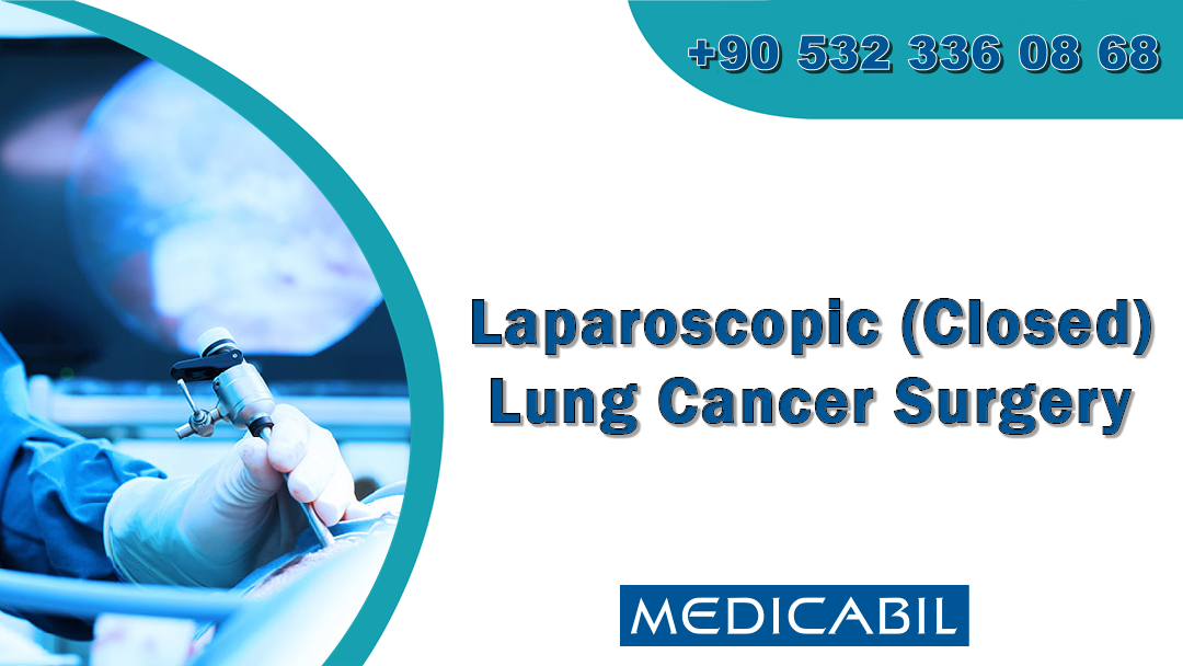 Laparoscopic (Closed) Lung Cancer Surgery