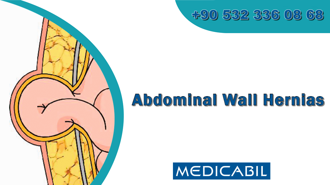 Abdominal Wall Hernias