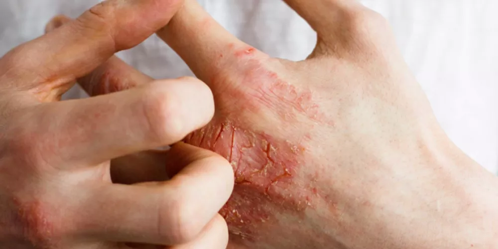 ما هو التهاب الجلد؟ لماذا يحدث ذلك؟ كيف يتم علاجها؟