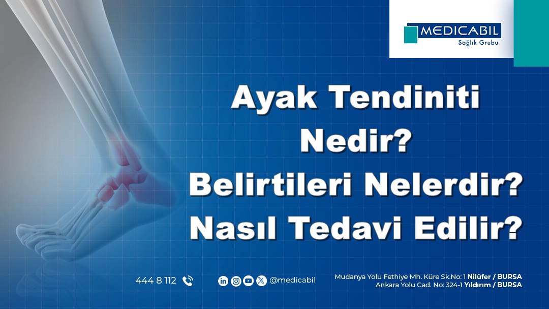 Ayak Tendiniti Nedir? Belirtileri Nelerdir? Nasıl Tedavi Edilir?