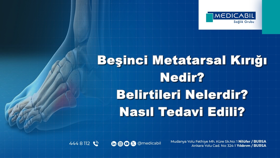 Beşinci Metatarsal Kırığı Nedir? Belirtileri Nelerdir? Nasıl Tedavi Edilir?