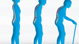 Osteoporoz (Kemik Erimesi) Nedir? Belirtileri Nelerdir?