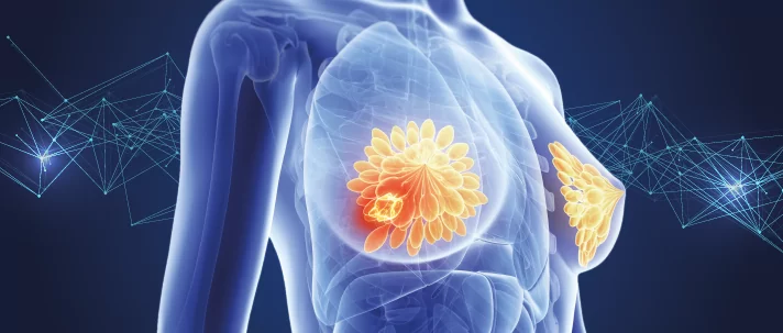 ما هو سرطان الثدي؟