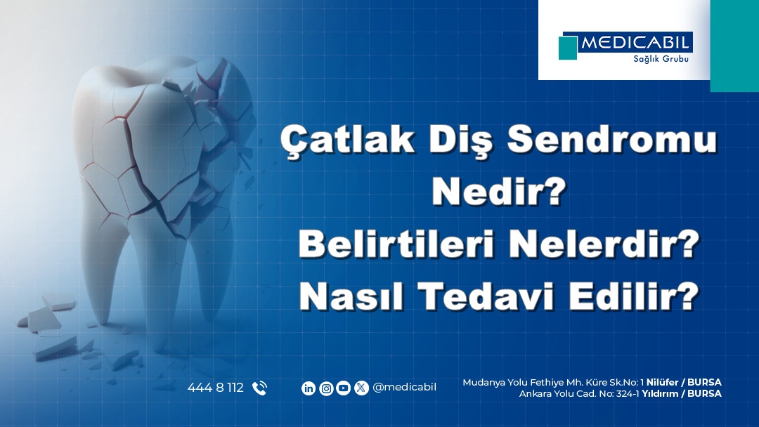 Çatlak Diş Sendromu Nedir? Belirtileri Nelerdir? Nasıl Tedavi Edilir?
