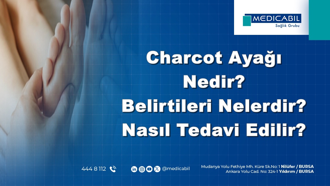 Charcot Ayağı Nedir? Belirtileri Nelerdir? Nasıl Tedavi Edilir?