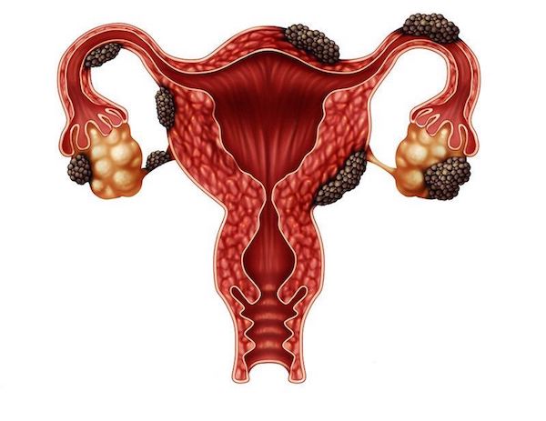 Çfarë Është Endometrioza (Cist Çokollatë)? Cilat Janë Simptomat? Si Të Trajtohet?