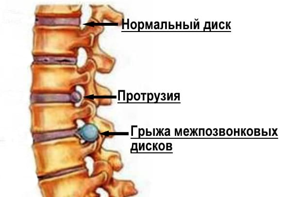 Почему возникает поясничная и шейная грыжа? Как лечится грыжа межпозвоночного диска?