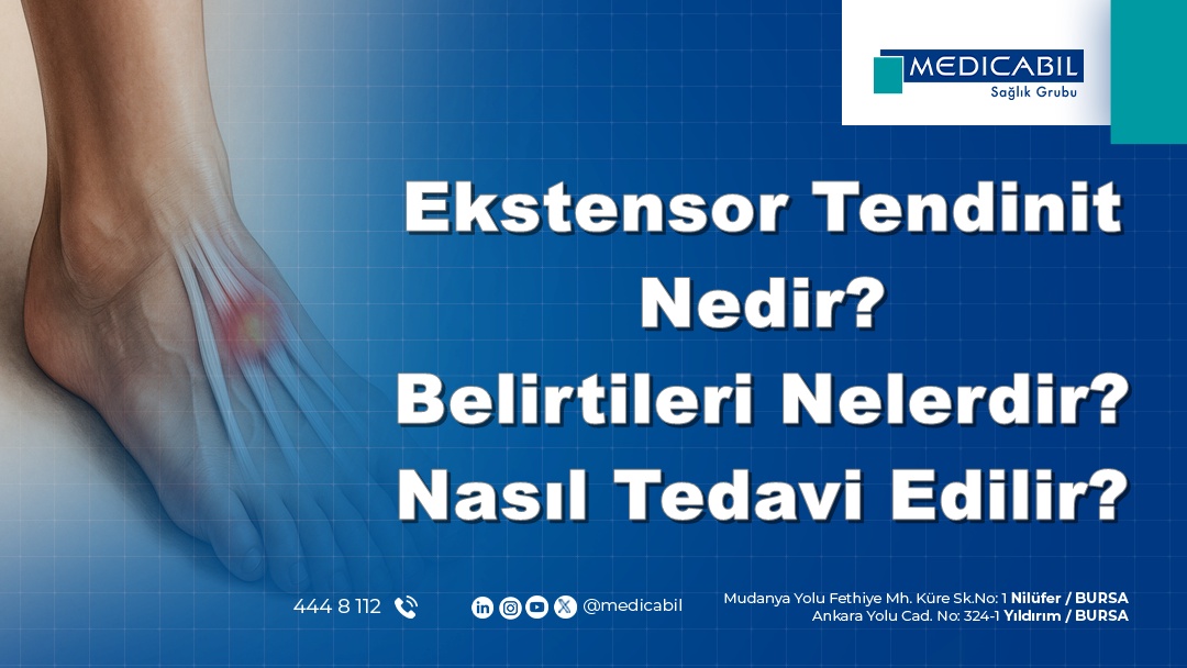 Ekstensor Tendinit Nedir? Belirtileri Nelerdir? Nasıl Tedavi Edilir?