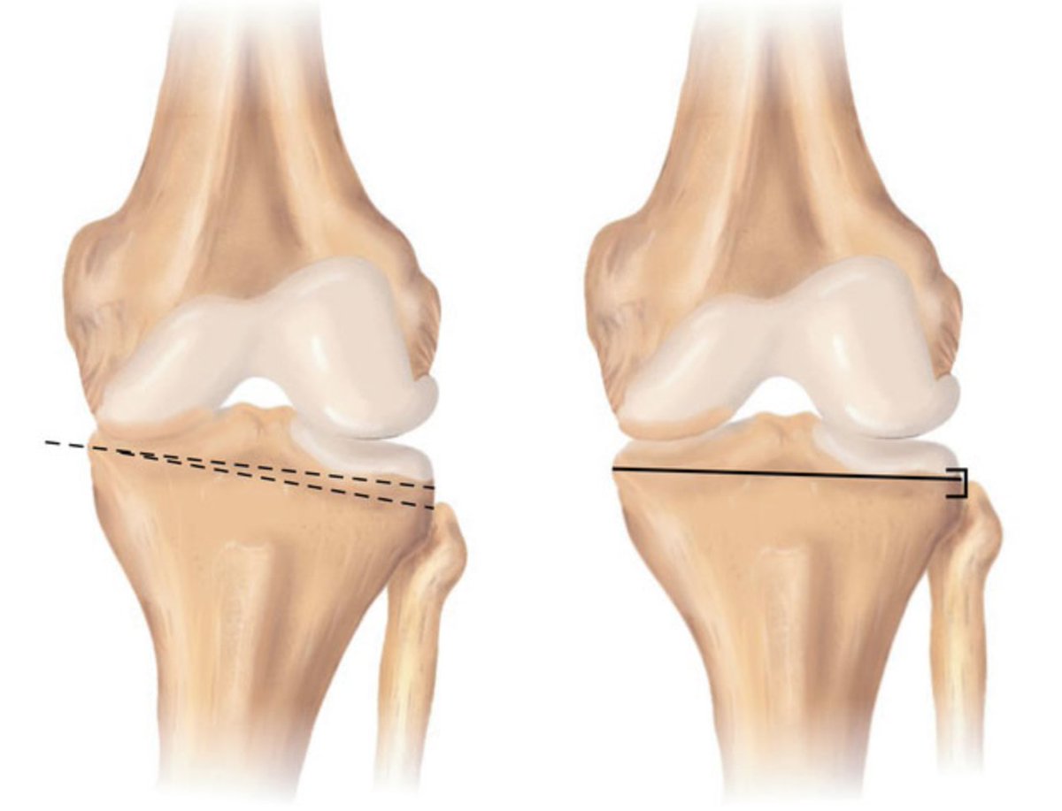 Düzeltme (Osteotomi) Ameliyatları