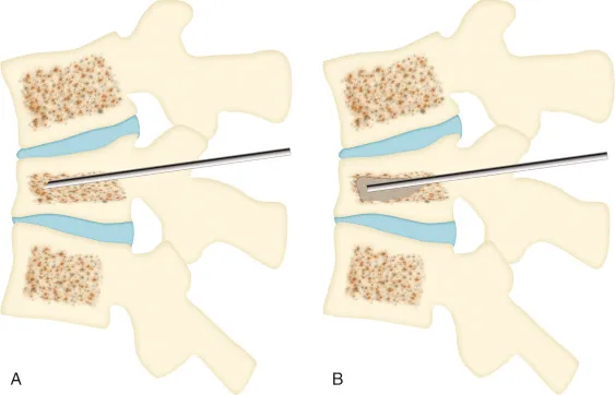 Çfarë Është Vertebroplastika? Çfarë Sëmundjesh Trajton? Cilat Janë Efektet Anësore Të Saj?