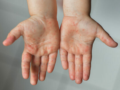 ما هو مرض  متلازمة اليد والقدم والفم؟ ما هي الاعراض؟ كيفية العلاج؟