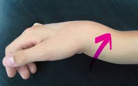 ما هو كسر السائق (كسر الكعبرة الإبرية)؟ ما أعراضه؟ كيف يُعالج؟