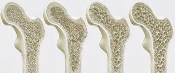 ما هو مرض هشاشة العظام؟ ما هي أعراضه؟ كيف يُعالج؟