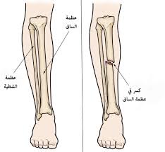 ما هي أسباب كسور الساق؟ ما هي الأعراض؟ كيف يتم علاجها؟