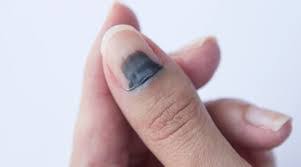 ما هو الورم الدموي تحت الظفر؟ ما هي أعراضه؟ كيف يُعالج؟