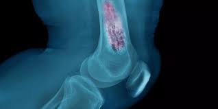 ما هو ورم الخلايا العملاقة في العظام؟ ما هي أعراضه؟ كيف يُعالج؟