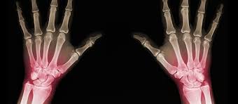 ما هو كسر بارتون؟ ما أسبابه؟ كيف يُعالج؟