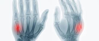 ما أسباب كسور المعصم؟ ما أعراضها؟ كيف تُعالج؟