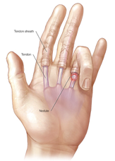 ما هو الإصبع الزنادي؟ كيف يتم علاجها؟
