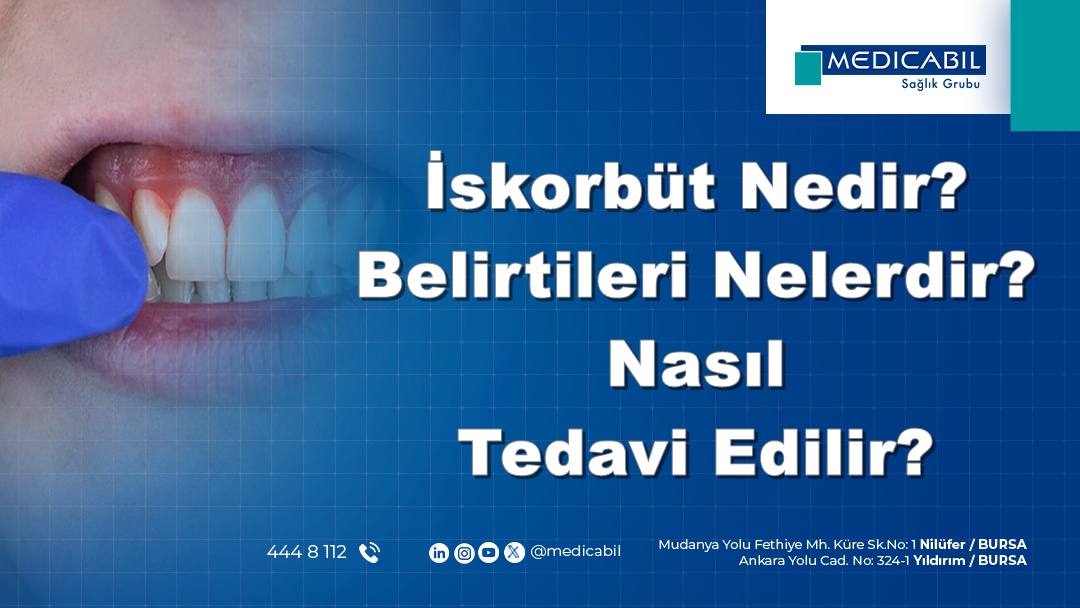 İskorbüt Nedir? Belirtileri Nelerdir? Nasıl Tedavi Edilir?