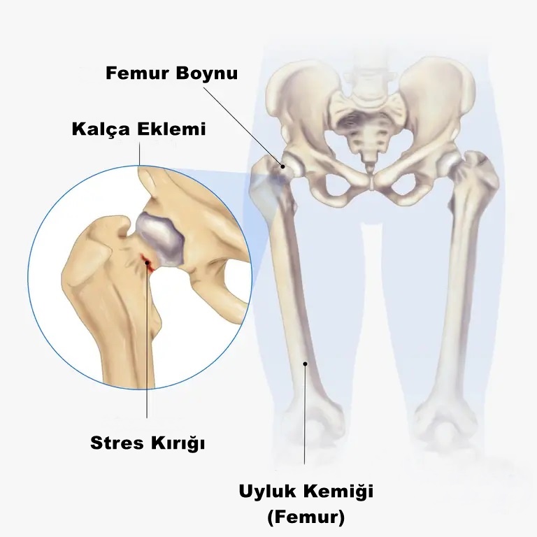 Kalça stres kırığı