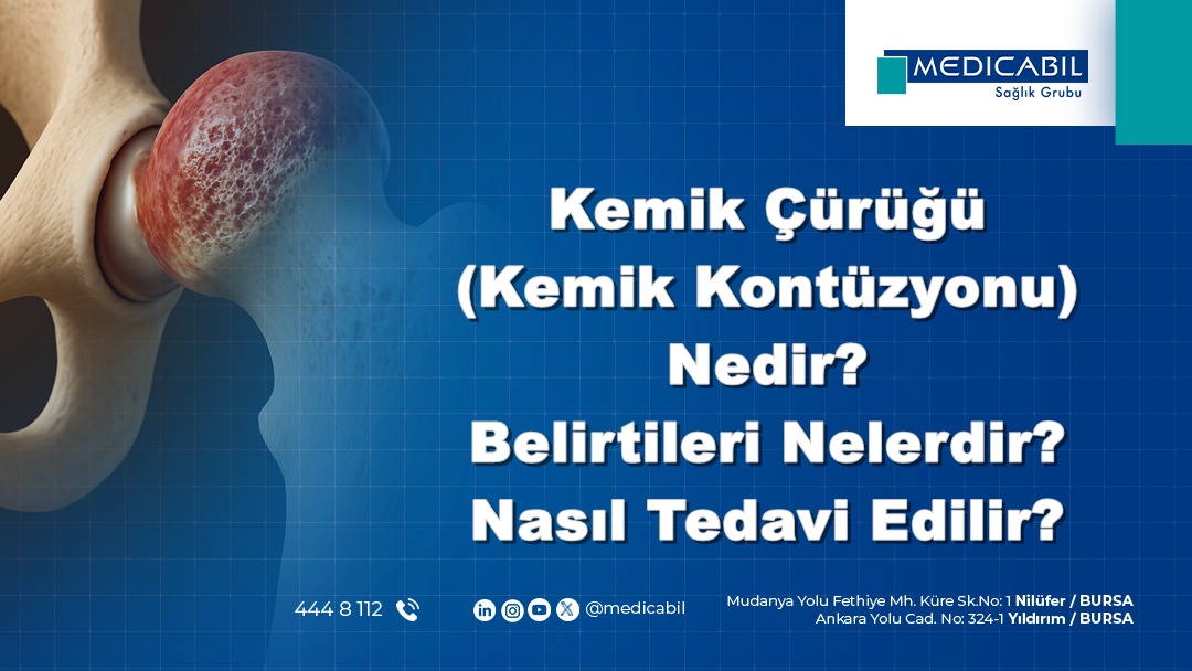Kemik Çürüğü (Kemik Kontüzyonu) Nedir? Belirtileri Nelerdir? Nasıl Tedavi Edilir?