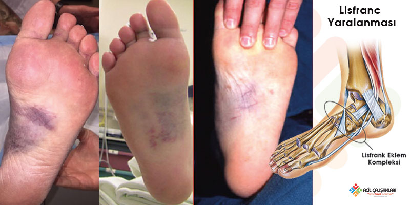 Çfarë Është Dëmtimi Lisfranc? Cilat Janë Simptomat? Si Trajtohet?