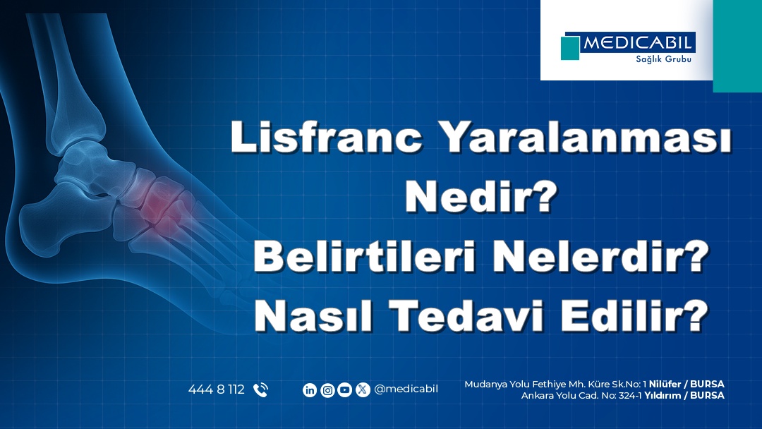 Lisfranc Yaralanması Nedir? Belirtileri Nelerdir? Nasıl Tedavi Edilir?