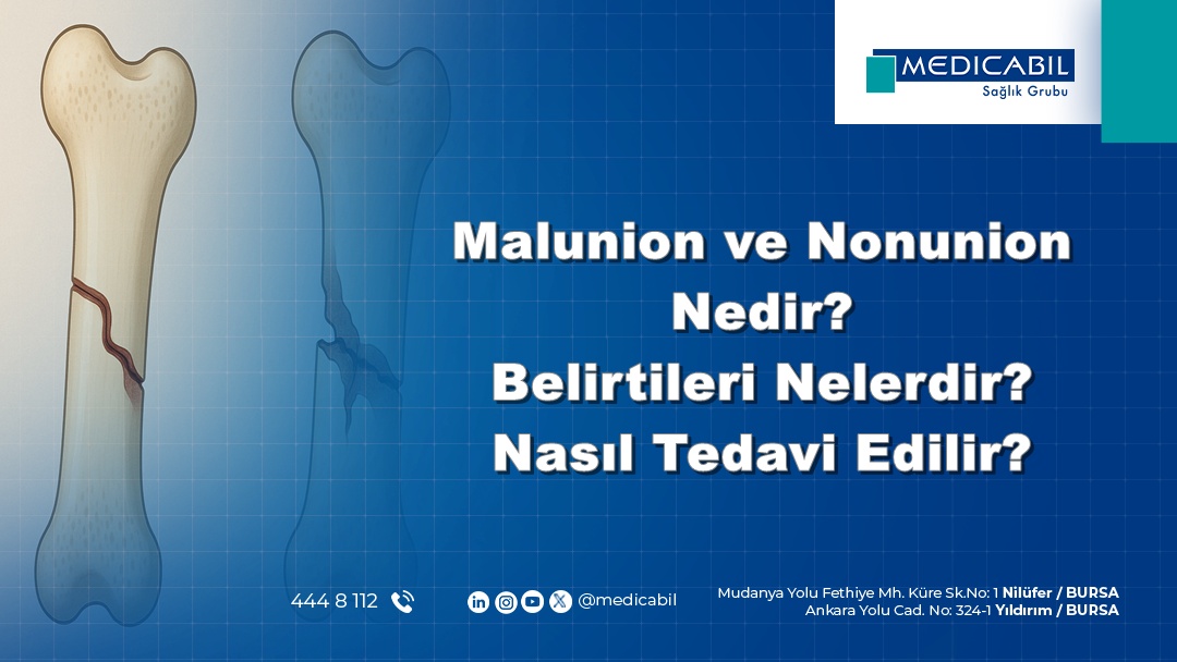 Malunion ve Nonunion Nedir? Belirtileri Nelerdir? Nasıl Tedavi Edilir?