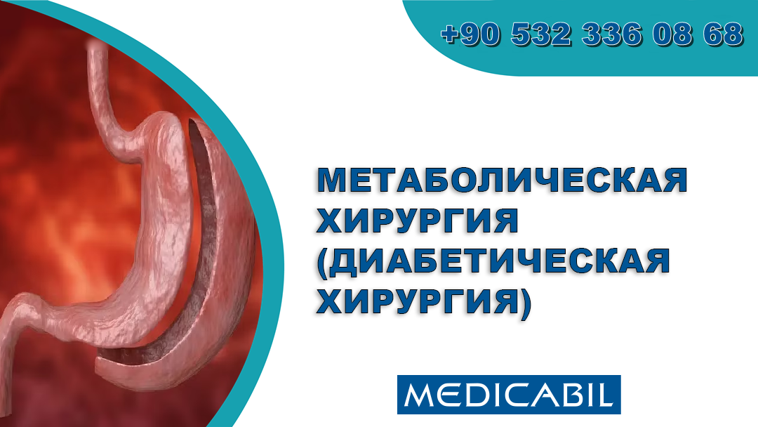Метаболическая хирургия (диабетическая хирургия)