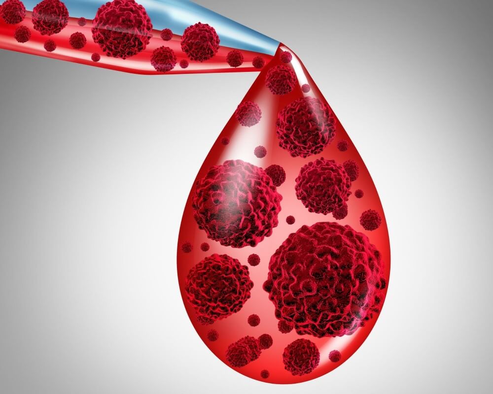 Çfarë është Mieloma Multiple? Cilat Janë Simptomat e Saj? Si Trajtohet?