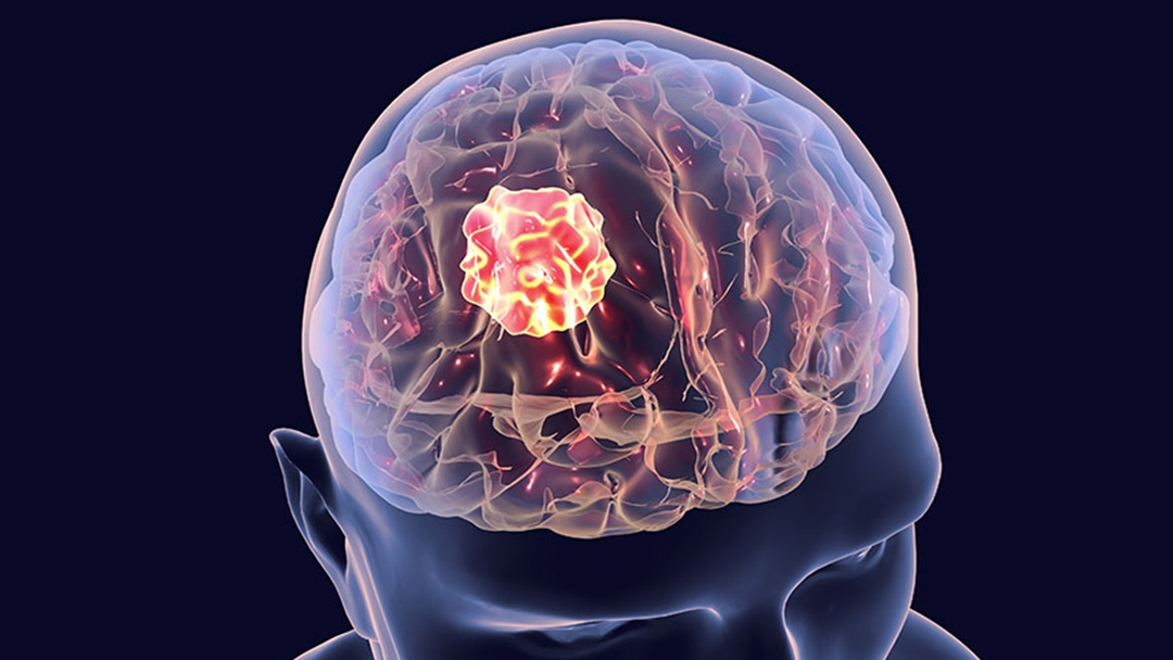 جراحة ورم الدماغ باستخدام الملاحة العصبية