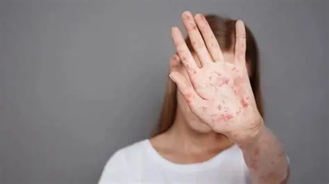 Çfarë është Sifilisi? Cilat Janë Simptomat e Tij? Si Trajtohet?