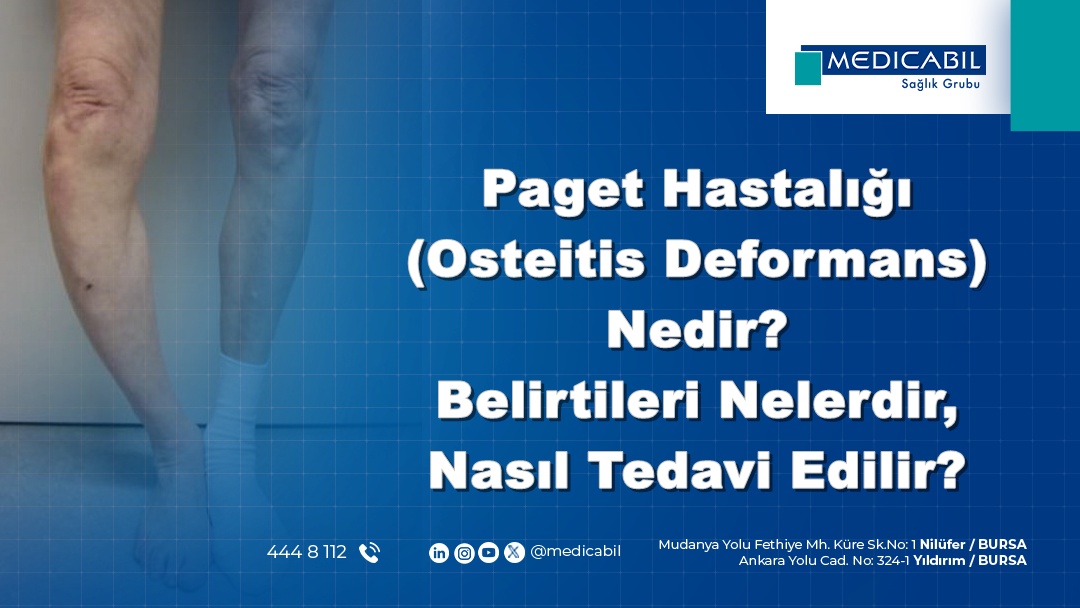 Paget Hastalığı (Osteitis Deformans) Nedir? Belirtileri Nelerdir? Nasıl Tedavi Edilir?