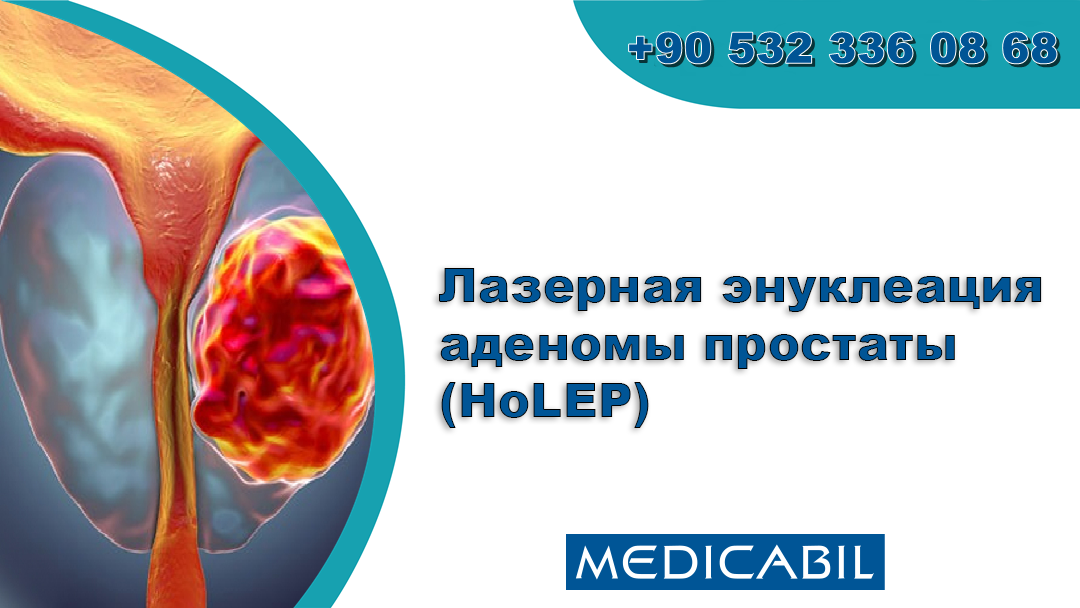 Лазерная энуклеация аденомы простаты (HOLEP)