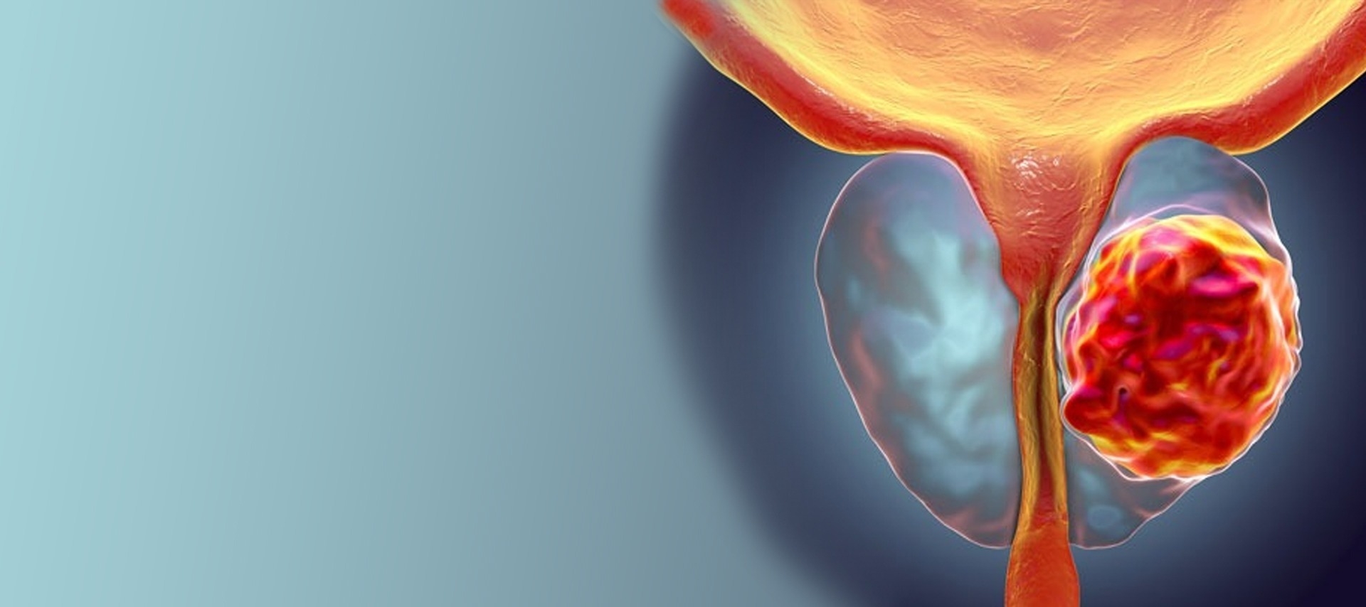 Prostate Surgery By HOLEP (Laser) Method Medicabil
