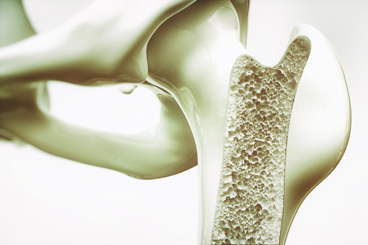 Çfarë Është Osteoporoza? Cilat Janë Simptomat e Saj? Si Trajtohet?