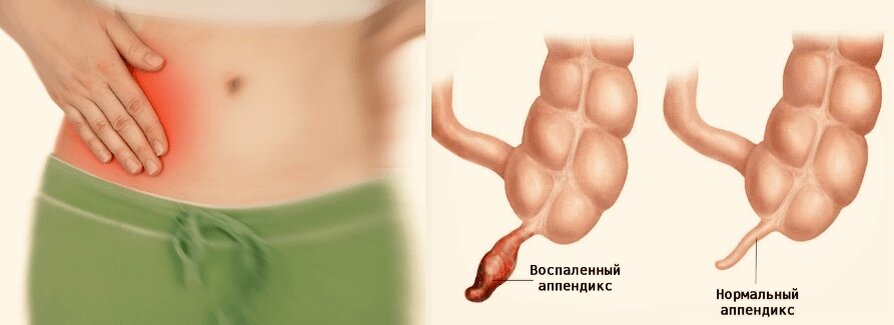 Как лечится аппендицит? Что такое аппендэктомия?