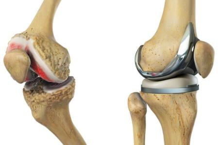 ما هي جراحة استبدال الركبة (تقويم مفاصل الركبة)؟ كيف تتم؟