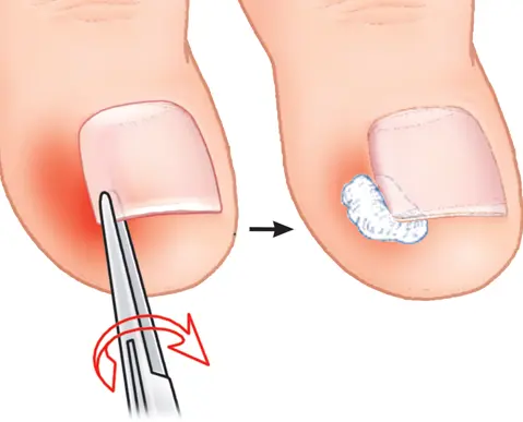 Что такое врастание ногтя на ноге? Почему возникает? Как лечится?