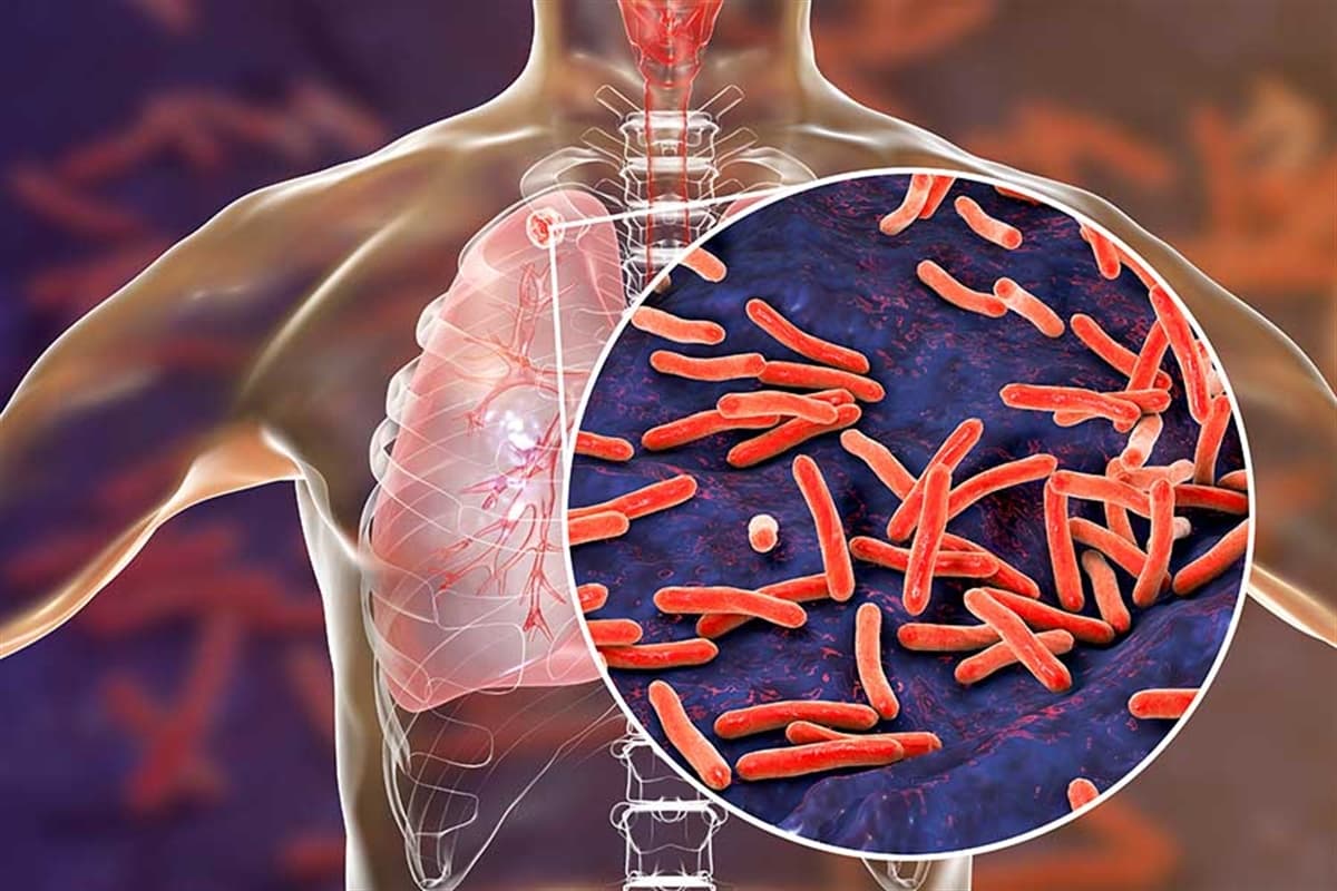 Çfarë Është Tuberkulozi?