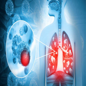 Çfarë Është Sëmundja e Legjionarëve? Cilat Janë Simptomat e Saj? Si Trajtohet?